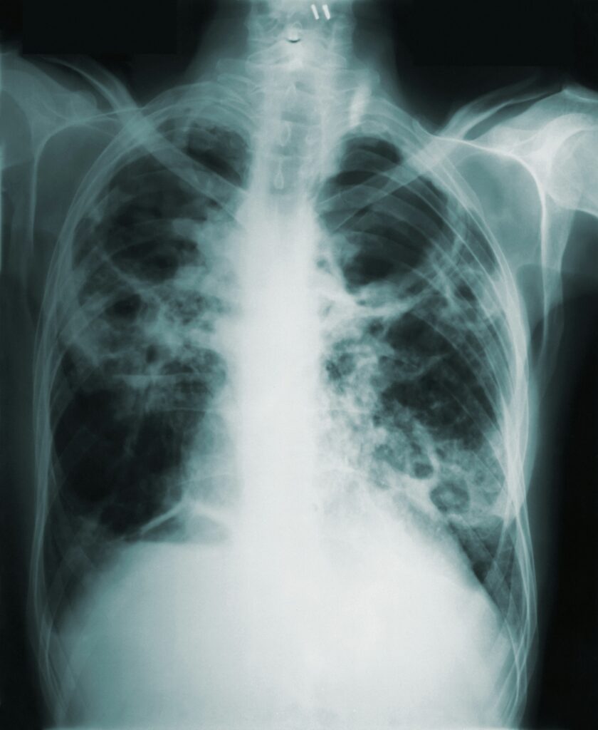 Prevenzione della VAP in Terapia Intensiva: strategie avanzate per la gestione del paziente ventilato