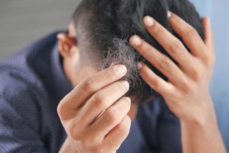 🧑‍🦲💥 Perdita di Capelli: Cause, Rimedi, Prodotti Efficaci e Soluzioni Definitive